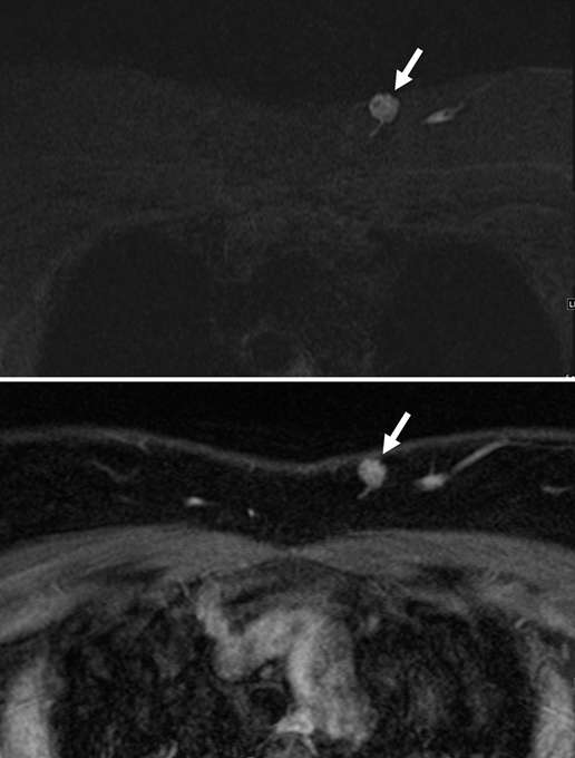 Arteriovenous malformation.