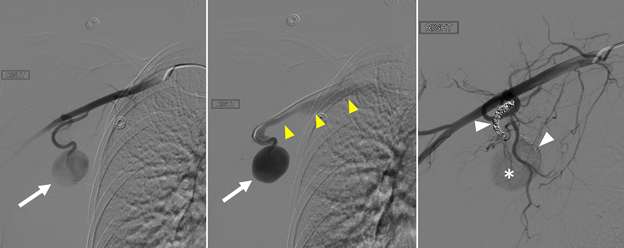 Pseudoaneurysm