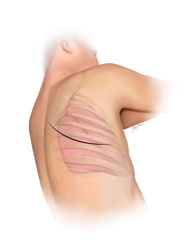 Detailed anatomical illustration of a human torso showing ribcage structure.