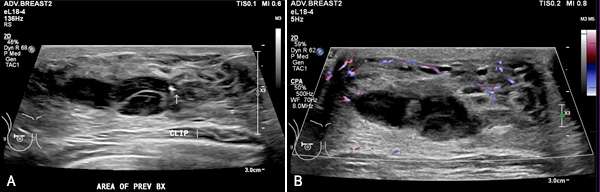 Case: Seromas and Hematomas Figure 3