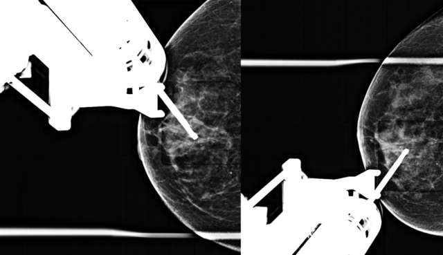 How to perform: Sterotactic (Mammographic guided biopsy) Figure 3