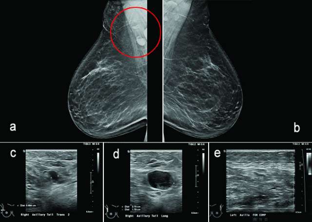 Case: Axillary Lymphadenopathy Figure 6