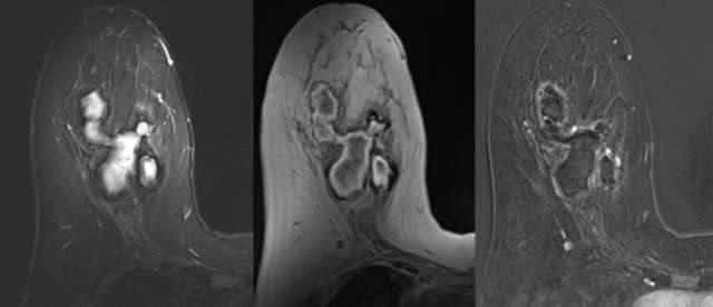 Case: Post-Surgical Fluid Collections Figure 3