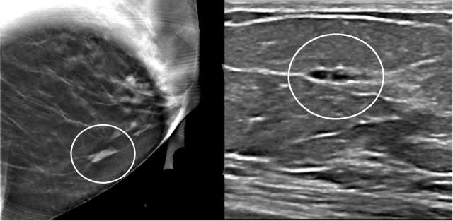 Case: Atypical Ductal Hyperplasia Figure 4