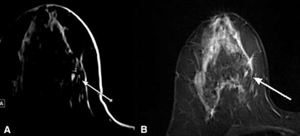 Case: Fibroadenomas and Phyllodes Tumors Figure 3
