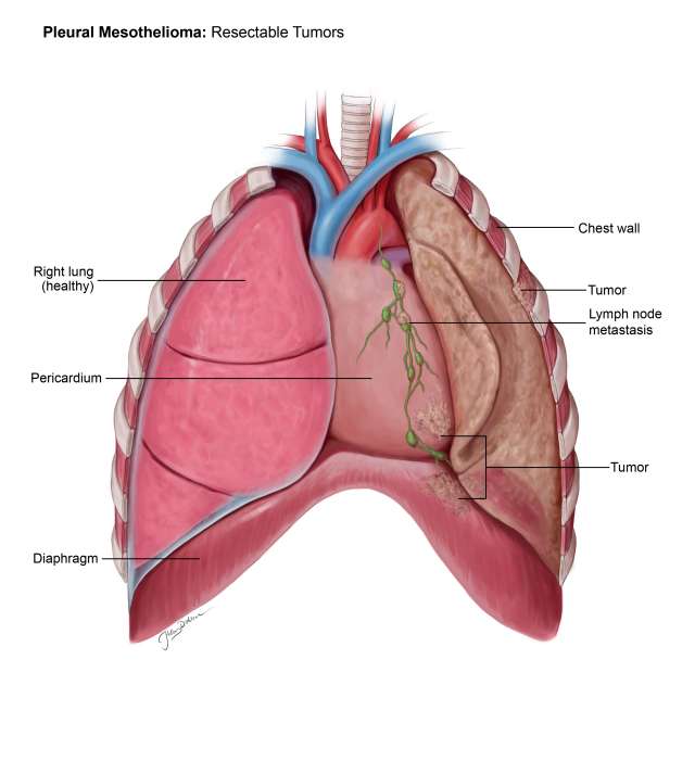 Diagram of the human lungs, highlighting pleural mesothelioma and related tumors.