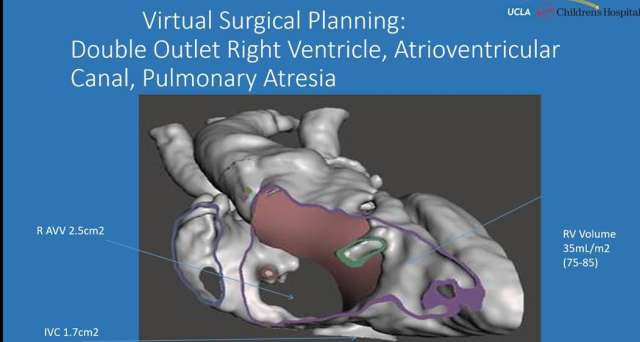 atheter-based implantation of pulmonary valves