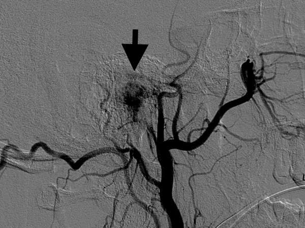 Embolization 1