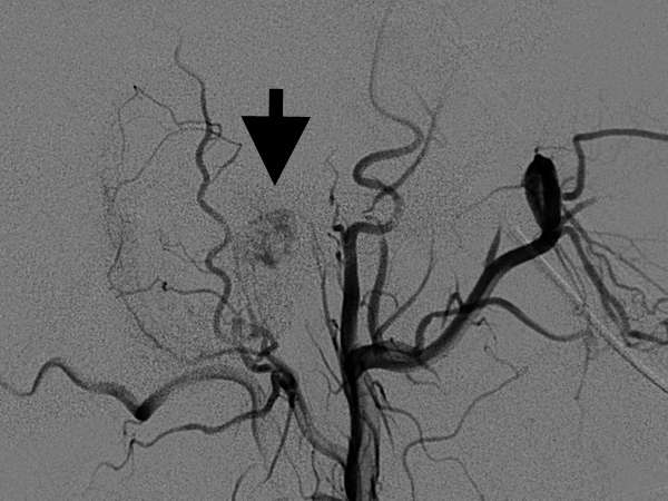 Embolization 2