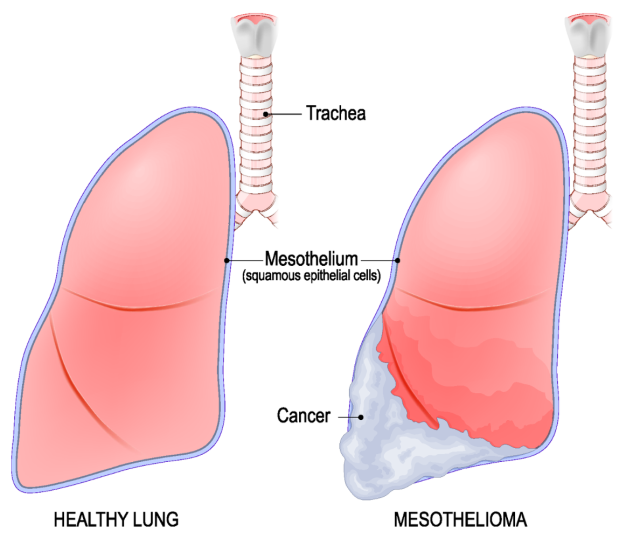 Diagram comparing a healthy lung to a lung with mesothelioma, highlighting cancer in the mesothelium.