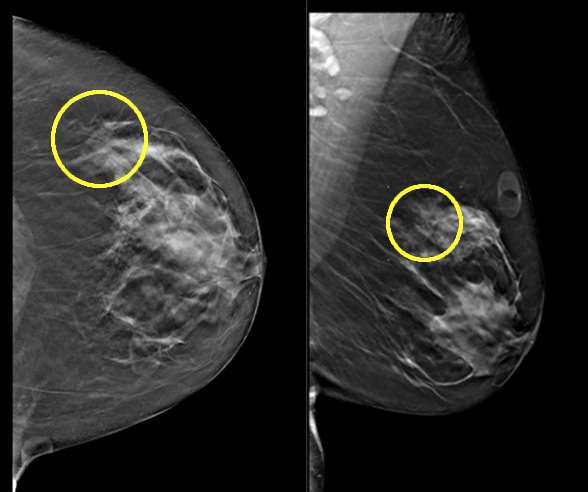 Case: Atypical Lobular Hyperplasia Figure 1
