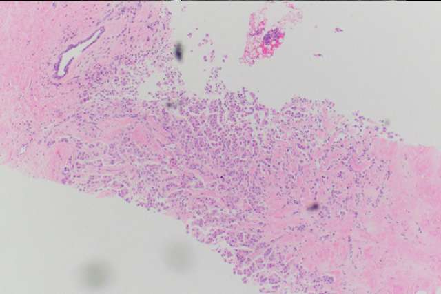 Breast Tissue