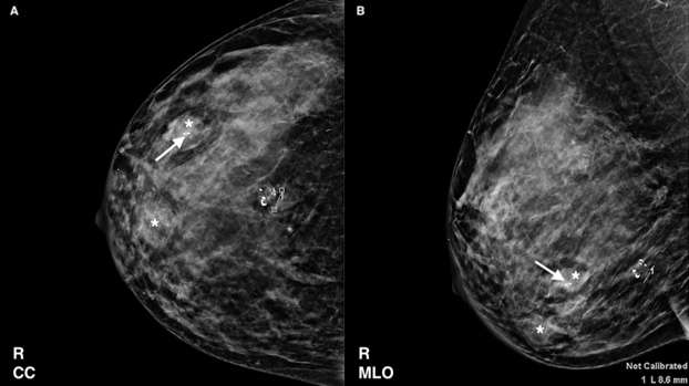 Case: Fibroadenomas and Phyllodes Tumors Figure 2