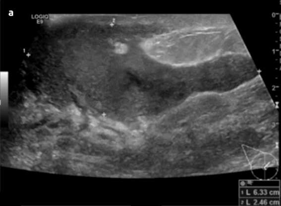 Case: Mastitis Figure 1