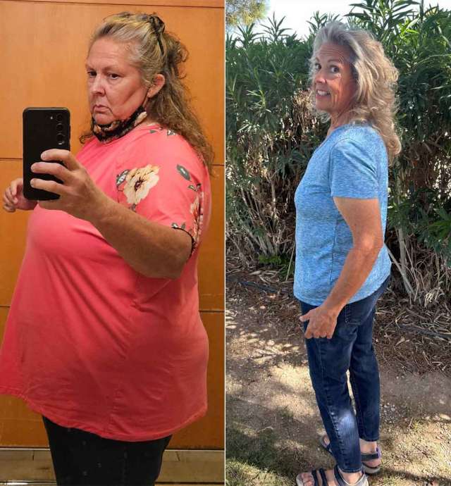 Ruth before and after Gastric Sleeve Surgery at UCLA.