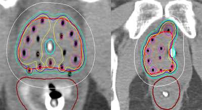 hdr-prostate-leader