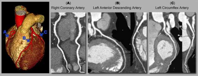 Low Dose CCTA