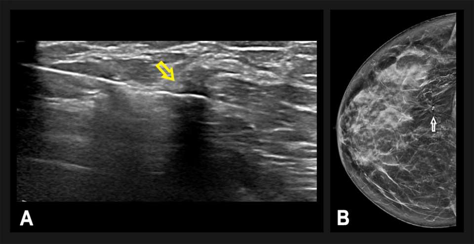 Ultrasound image showing a highlighted area of interest, alongside a mammogram image.