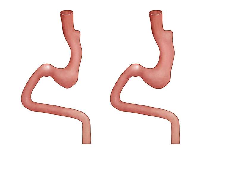 Increase of stomach volume after gastric sleeve.