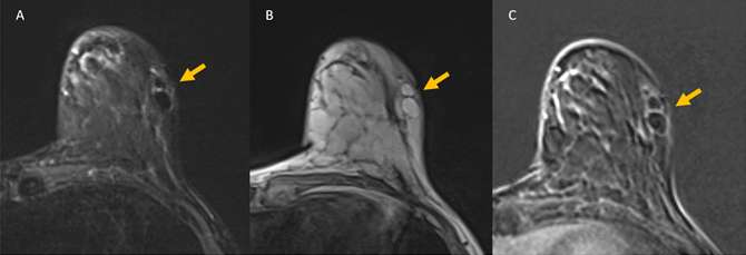 Case: Fat Necrosis of Breast Figure 4