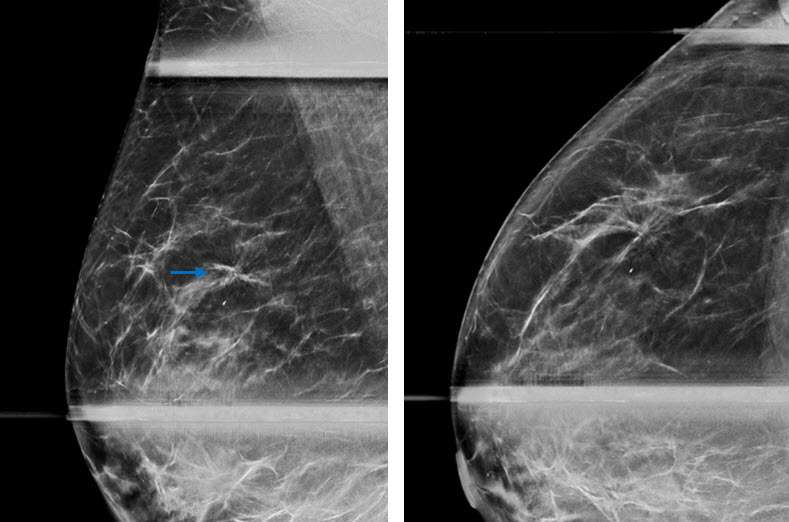 Case: Radial Schlerosing Lesions Figure 1a