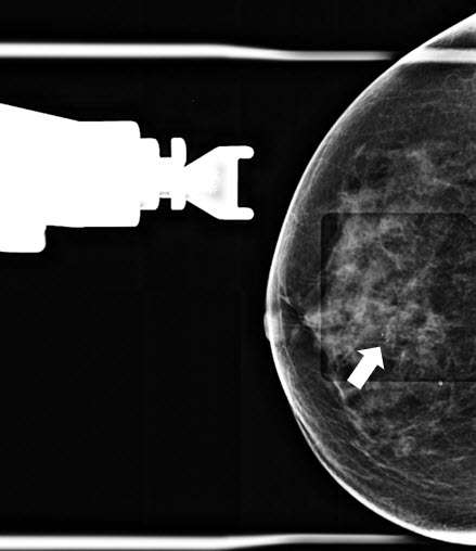 How to perform: Sterotactic (Mammographic guided biopsy)