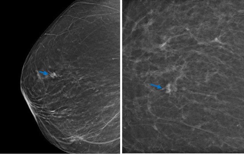 Case: Radial Schlerosing Lesions Figure 2a