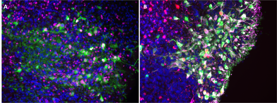 Microscopic image of tumor cells transplanted into a cortical organoid, visualizing cells within the organoid structure for cancer research.