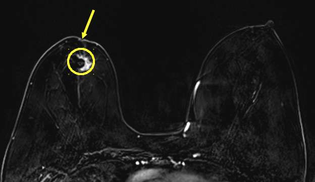 Case: Skin and Nipple Changes Figure 5