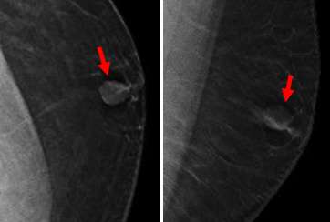 Case: Malignant Male Breast Lesions Figure 1