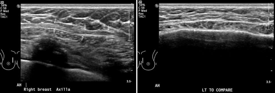 Case: Sternalis Muscle Figure 5