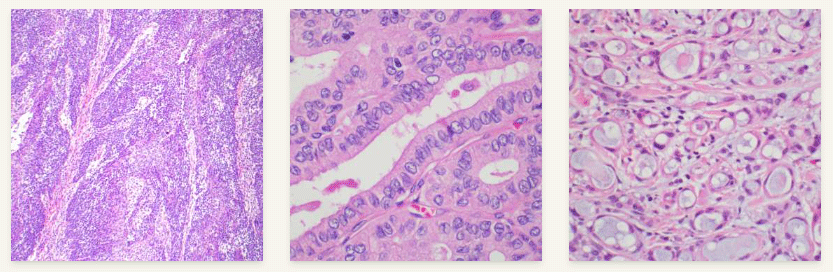 Microscopic images of cancerous tissue samples showing cellular structures stained with hematoxylin and eosin (H&E).