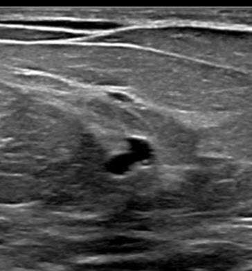 Case: Radial Schlerosing Lesions Figure 2b