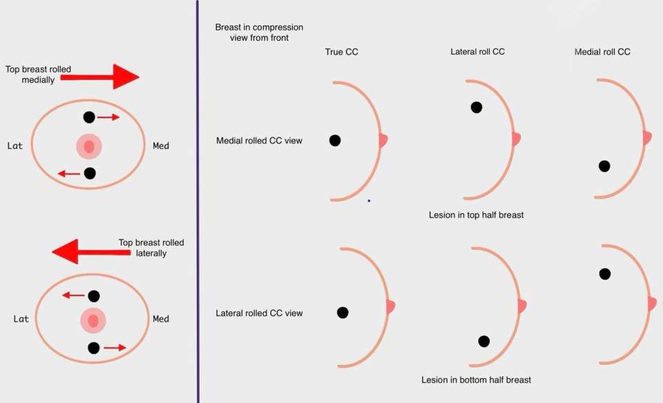Screening Mammogram: Breast Lesion Localization Figure 6