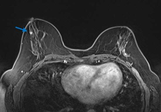 Case: Radial Schlerosing Lesions Figure 3