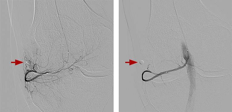 Genicular artery embolization process diagram