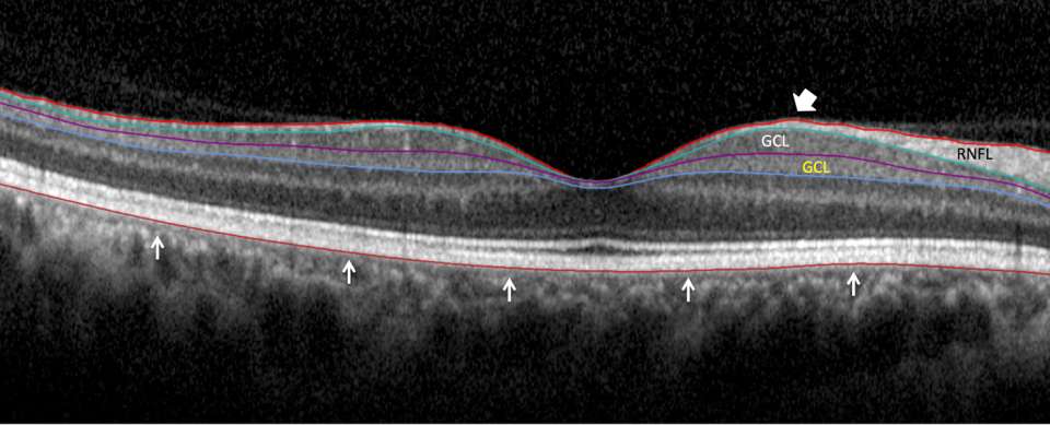 Macular OCT Imaging