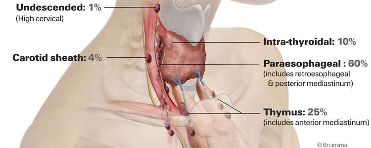 Re-do Parathyroid Surgery