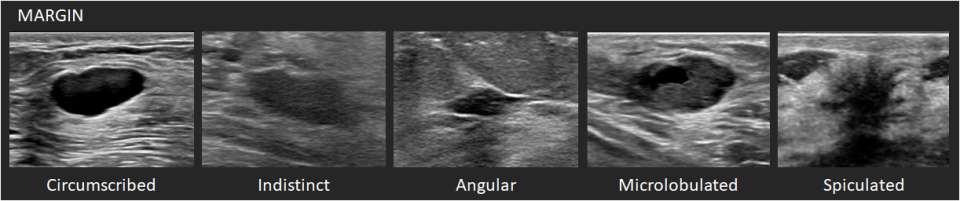 Ultrasound Mass Margin