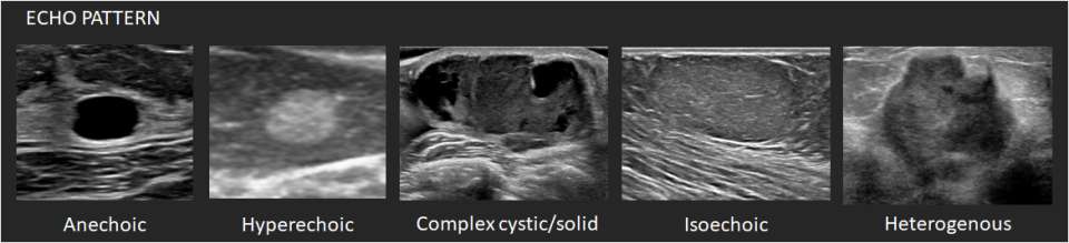 Ultrasound Mass Echo Pattern
