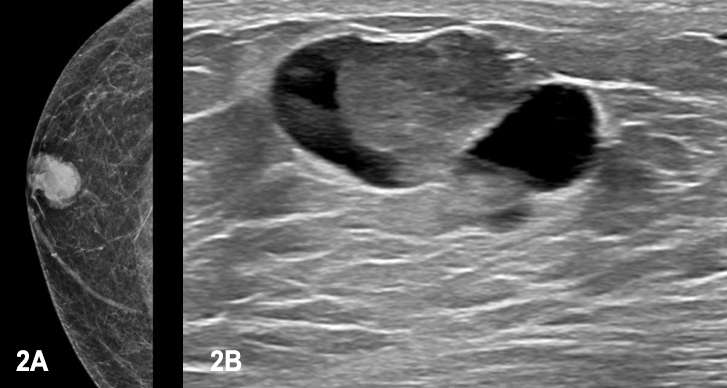 Case: Papillary Carcinoma Figure 2
