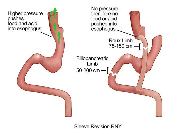 Illustration of gastric sleeve revision