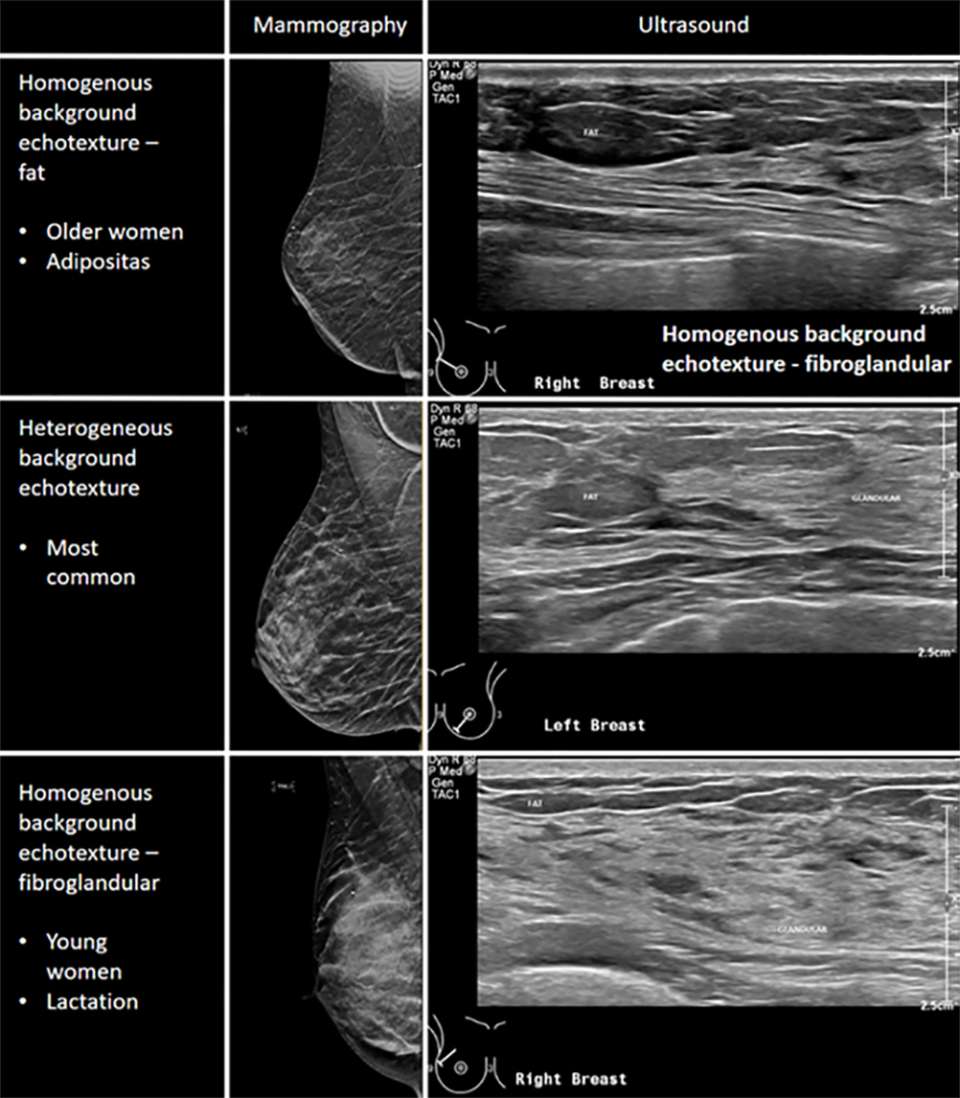 Medical diagram comparing mammography and ultrasound images of breast tissue, illustrating homogeneous fat, heterogeneous, and fibroglandular patterns.