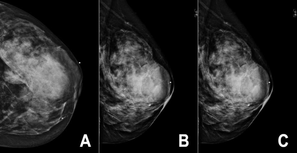 Case: Breast Sarcoma Figure 1