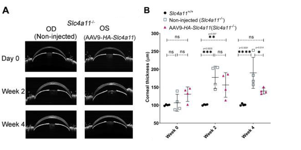 Corneal Edema Fig. A-B