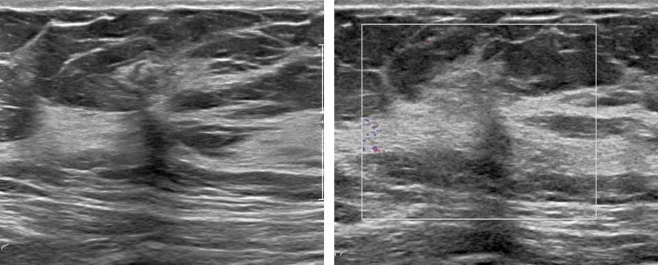 Case: Radial Schlerosing Lesions Figure 1b