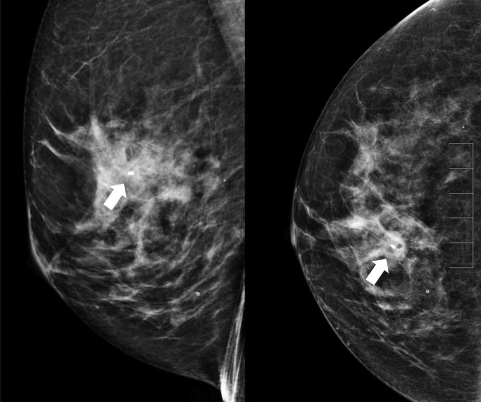How to perform: Sterotactic (Mammographic guided biopsy) Figure 7