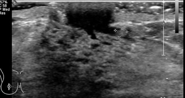 Procedure Ductography Figure 2