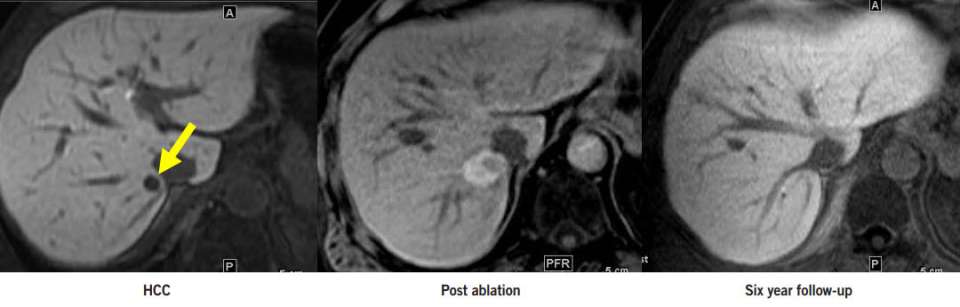 Before and after treatment diagram of liver