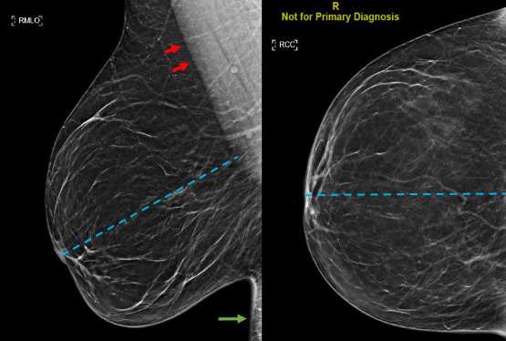 The posterior nipple line 